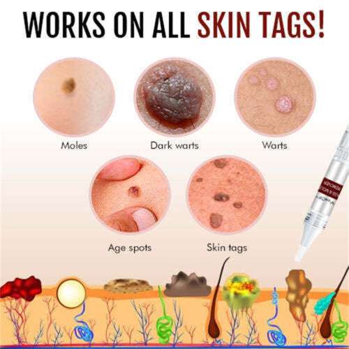 🤩Tags & Moles Remover just in 5 days [Buy 1 Get 1 free]🤩