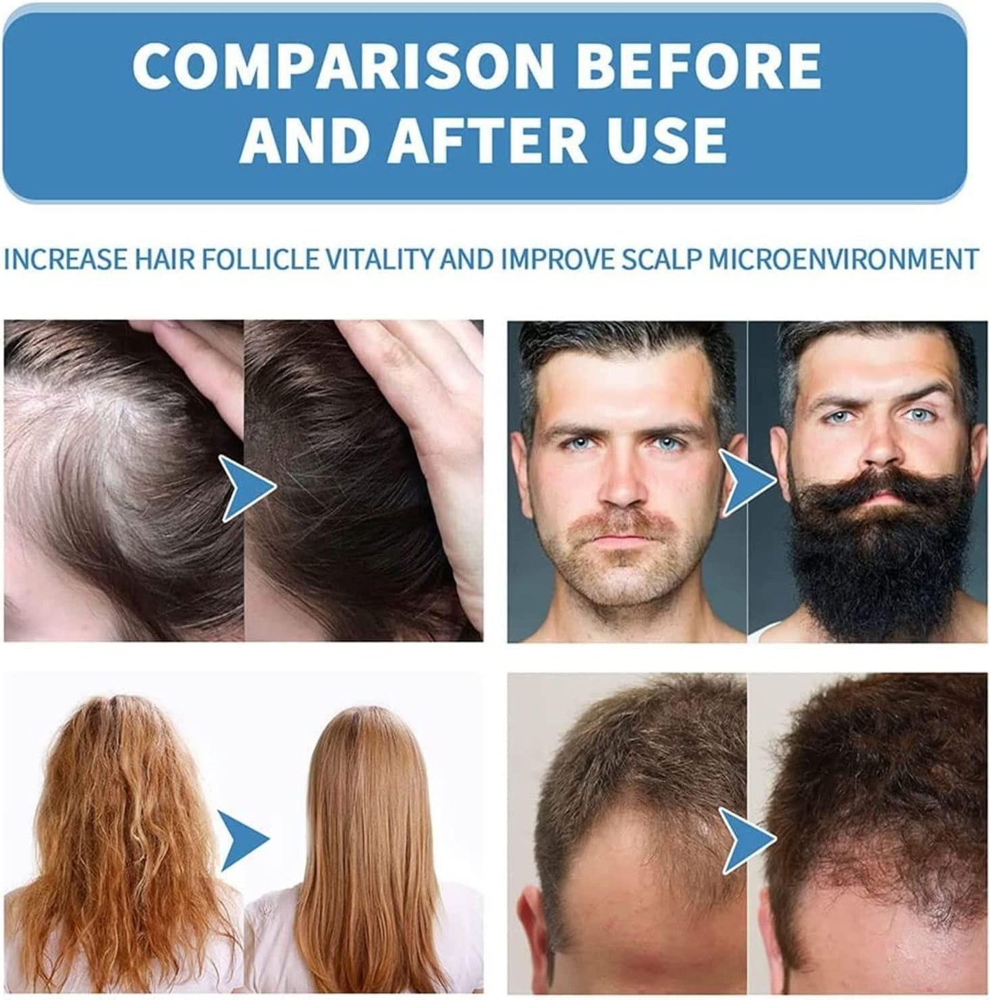 🤩 Minoxi™ Roll-On Hair Growth Serum - UNISEX 🔥[BUY 1 GET 1 FREE]🔥