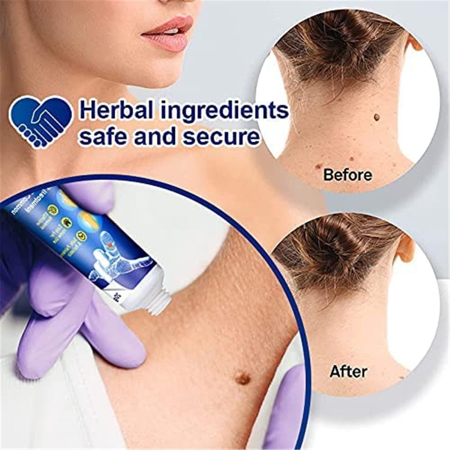 🤩Natural Herbal based Warts Remover Cream [Buy 1 Get 1 free]🤩