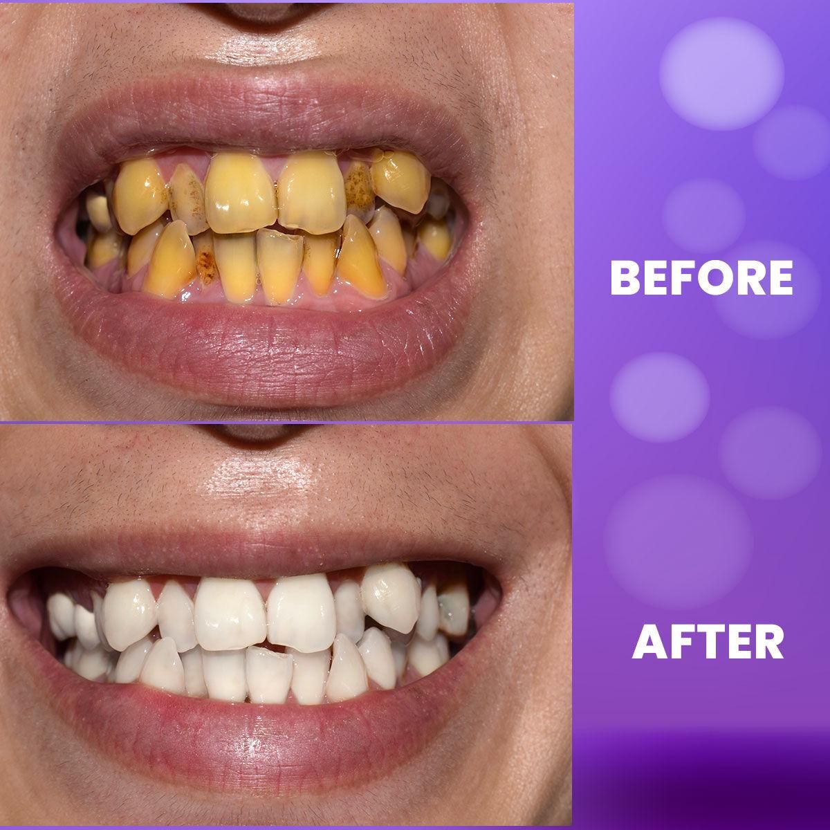 🤩Refreshing Purple Teeth Whitening Gel🤩