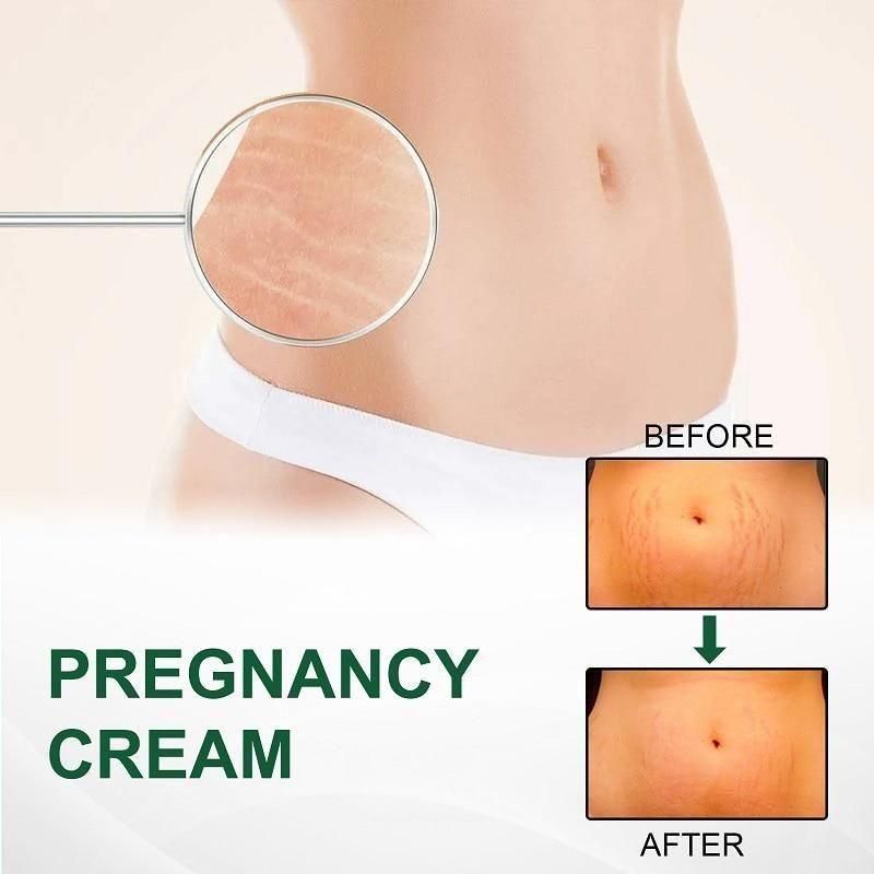 🤩KURAI Pregnancy Scars and Acne Removal Cream🤩