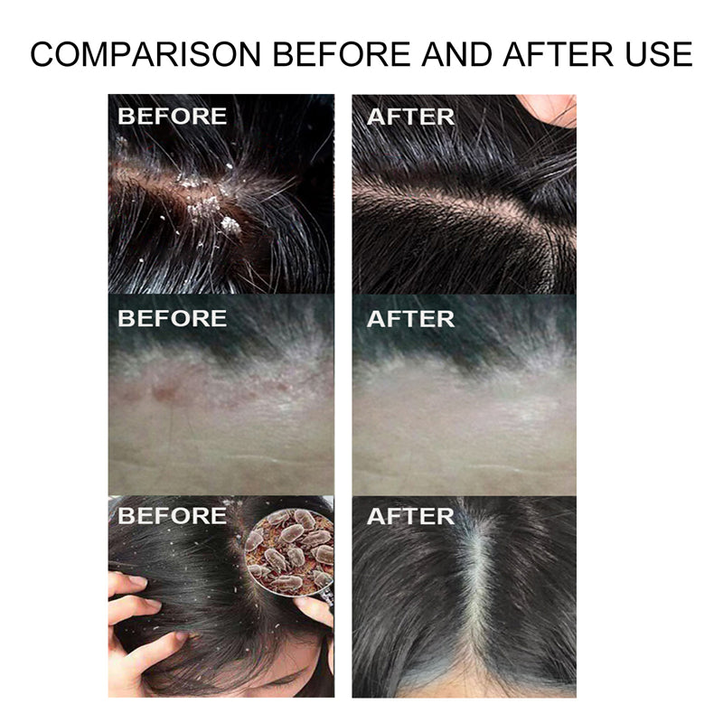 🤩Sulfur Shampoo for Removal of Dandruff and Hair Breakage [Buy 1 Get 1 Free]🤩