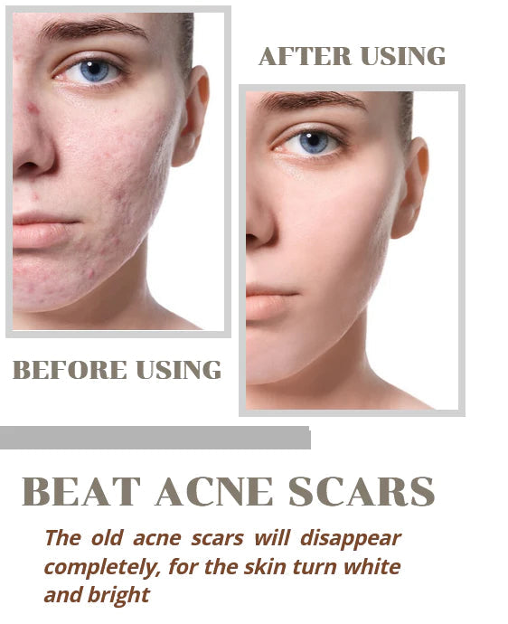 🤩Niacid Face Serum Fight And Fade Acne Marks [🔥Buy 1 Get 1 Free🔥]🤩